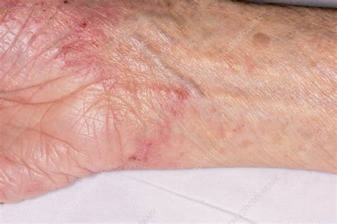Eczema Stock Image C0549376 Science Photo Library