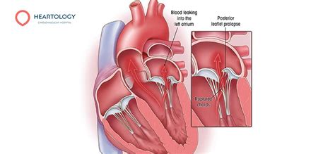Mvr Mitral Valve Replacement Untuk Jantung Heartology
