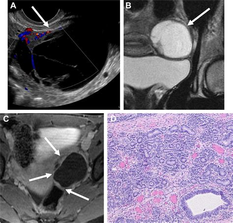Sex Cord Stromal Tumors Of The Ovary Radiologic Clinics