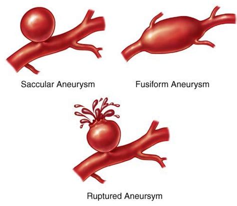 Best Images About Avm Aneurysm Arteriovenous Malformation On