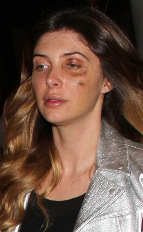 Brittny Gastineau Steps Out With Black Eye Files Police Report E Online