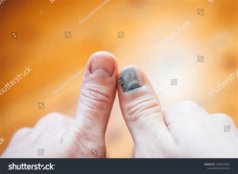 257 Subungual Hematoma 이미지 스톡 사진 및 벡터 Shutterstock