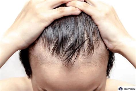 The Signs Of Balding At 20 How To Identify And Treat Hair Loss
