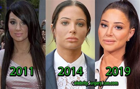 Tulisa Plastic Surgery Lips Cheeks Fillers Before And After