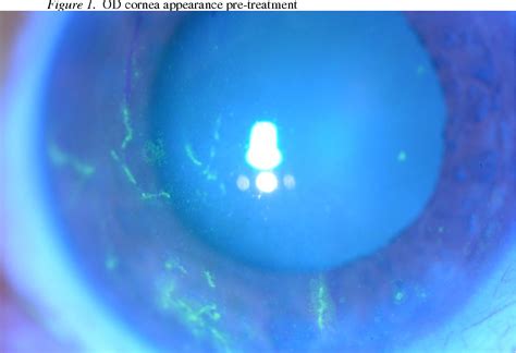 The two treatment groups would correspond to the test acyclovir cream 5% (t) and the rld (r). Figure 1 from Late dendriform keratitis in herpes zoster ...