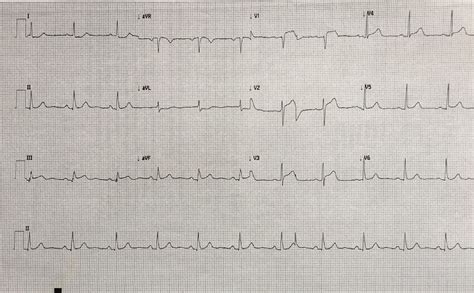 The 12 Lead Electrocardiogram Showing Extensive Septa
