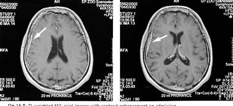 Figure 1 From Idiopathic Hypertrophic Pachymeningitis Case Report And