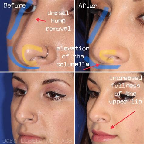 Rhinoplasty Dr Dara Liotta