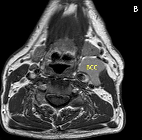 Branchial Cleft Cyst Bcc Mri Online