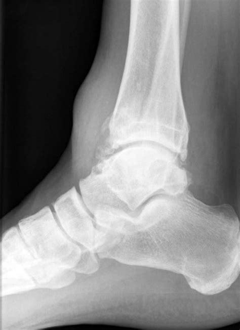 Lateral Malleous The Foot And Ankle Online Journal