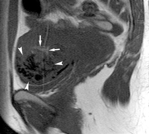 Diffusely Enlarged Uterus Evaluation With Mr Imaging Radiographics