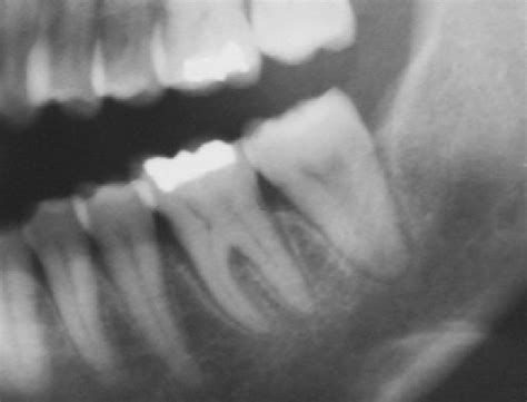 Widening Of Periodontal Ligament Space In Tooth 36 Download