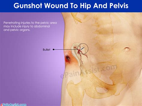 Gunshot Wound To Hip And Pelvis