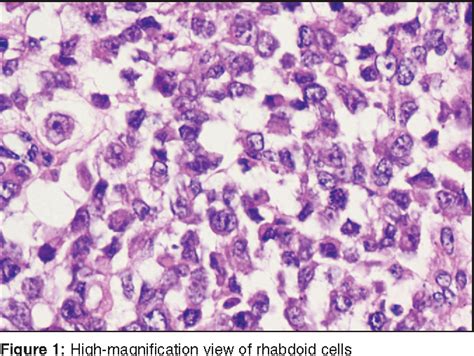 Figure 1 From Malignant Extrarenal Rhabdoid Tumor Of The Vulva In An