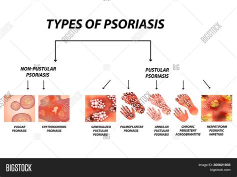 Types Psoriasis Image And Photo Free Trial Bigstock