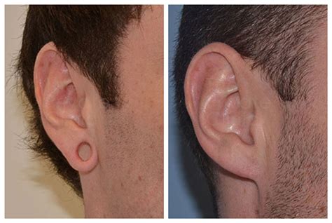 Earlobe Repair Near Me Earlobe Reshaping And Reduction Stretched