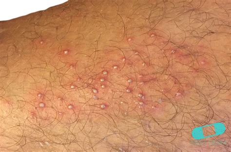 Itchy Red Bumps And Common Causes First Derm Blog