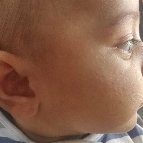 Parentingclinicbabyskincare Hello Dr My Baby Having Red Rashes At
