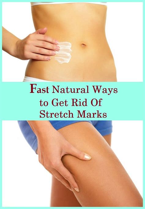 Fast Natural Ways To Get Rid Of Stretch Marks