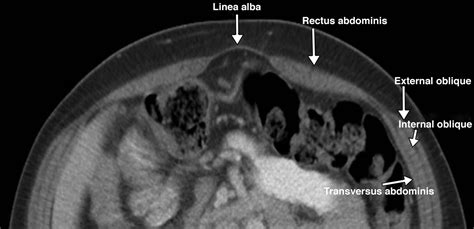 Incisional Hernia Repair What The Radiologist Needs To Know Ajr