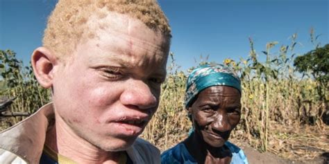 Malawi Albino Deaths For Body Parts On The Rise Report Canada