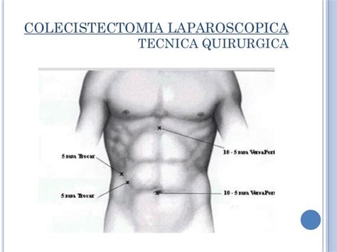 Colecistectomia Laparoscopica