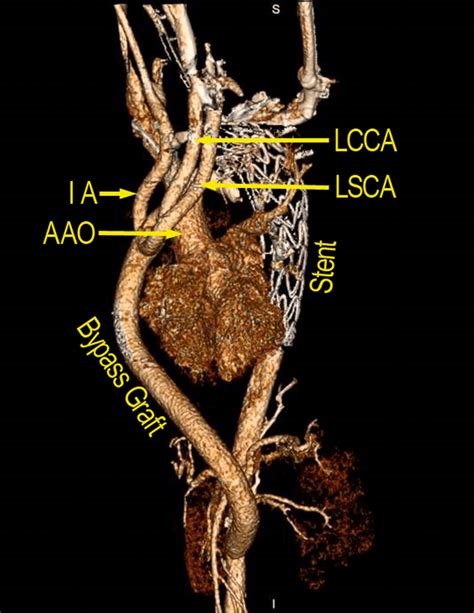 Aao Ascending Aorta Ia Innominate Artery Lcca Left Common Carotid