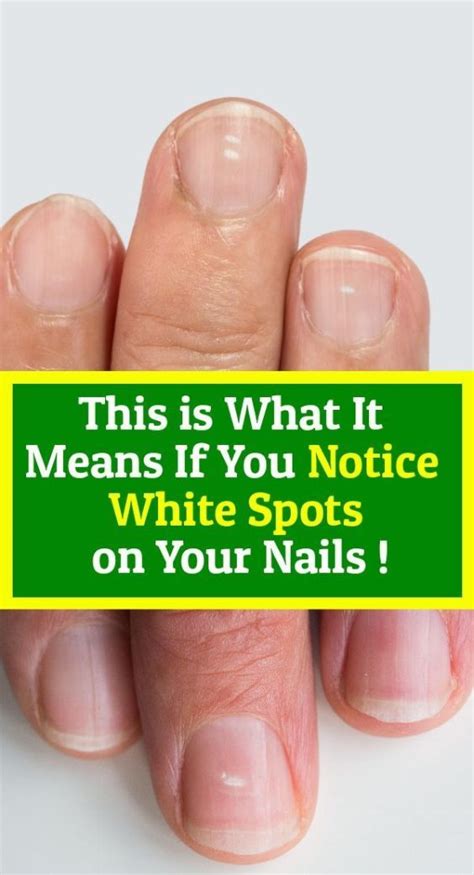 Famous What Do White Spots Under Your Nails Mean References