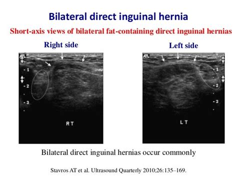 What Is Bilateral Fat Containing Inguinal Hernias Broken Curve