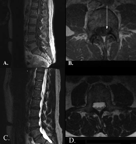 Preoperative Sagittal T1 Mri Sequence After Gadolinium Administration