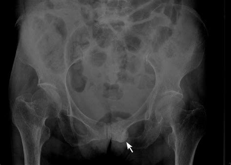Anteroposterior Radiograph Of The Pelvis Demonstrated A Focal Sclerotic