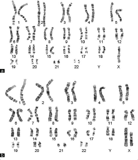 A Chromosome Analysis Showing One Of The Mosaic Karyotypes 45x B Download Scientific