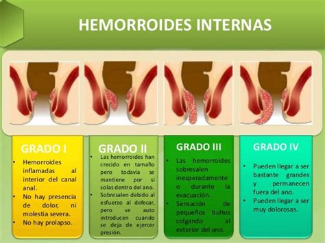 Foto De Hemorroides Inflamadas Foto De