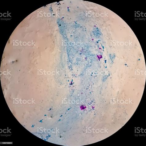 Sputum Smear Under Microscopy Showing Gram Positive Cocci Bacteria