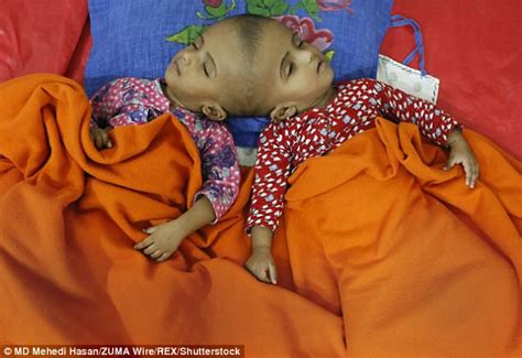 Conjoined Twins Could Be Separated In Op That Could Kill Daily Mail Online