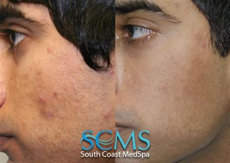 Pin On Laser Acne Scar Removal