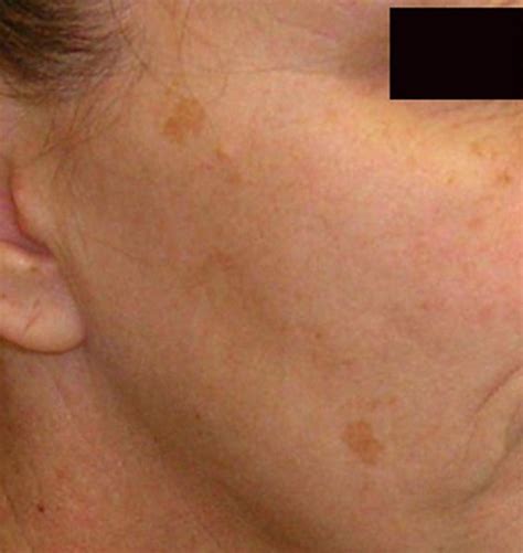 Little Brown Spots On Skin Pictures Photos