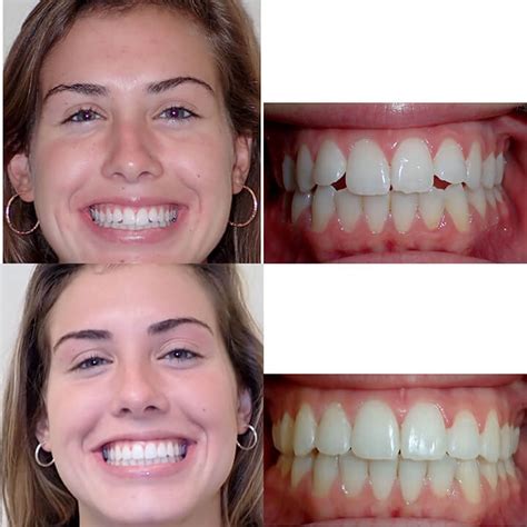 Before And After Invisalign Wazio Orthodontics