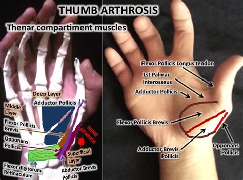 Thumb Arthrosis By Adhesions Osteopathic Treatment