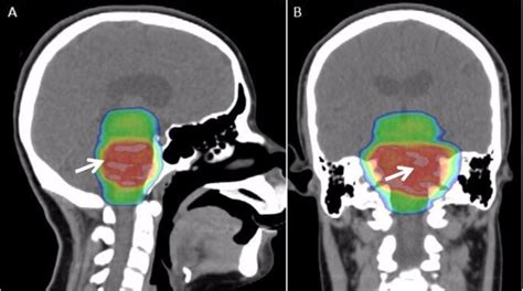 A prognosis is when your doctor gives you a forecast of the likely outcome of your medical condition. Two Latest Drug Treatment Advances for DIPG in 2017 ...