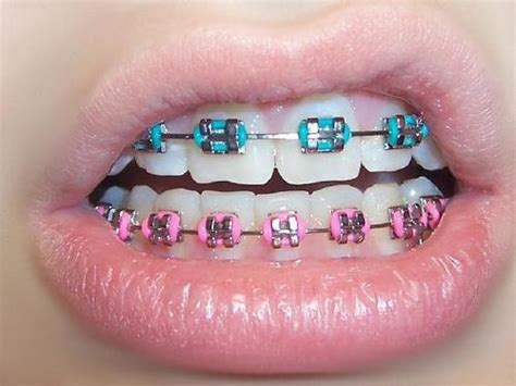 Pink Braces On Tumblr Coloring Wallpapers Download Free Images Wallpaper [coloring436.blogspot.com]