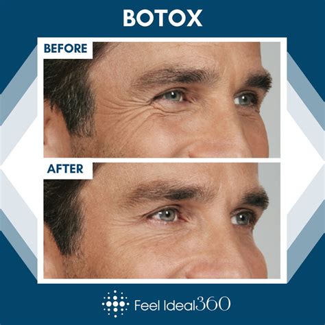 Botox Before And After Man Wrinkles Feel Ideal 360 Med Spa Southlake Tx
