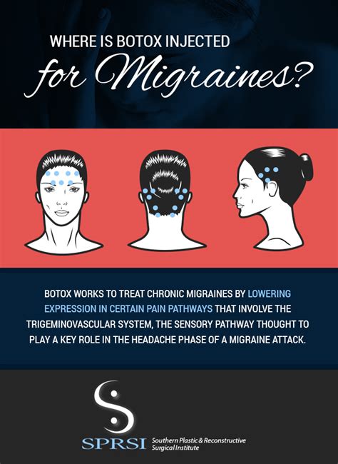 How Long For Botox To Work For Migraines Botox Injections For Migraines Migraine Treatment