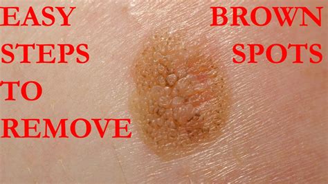 How To Get Rid Of Brown Spots On Skin Home Remedies Naturally At