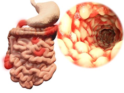 Hidradenitis Suppurativa Aziv Infusion Therapy Center