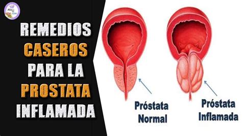 Remedios Caseros Para La Prostata Inflamada Youtube