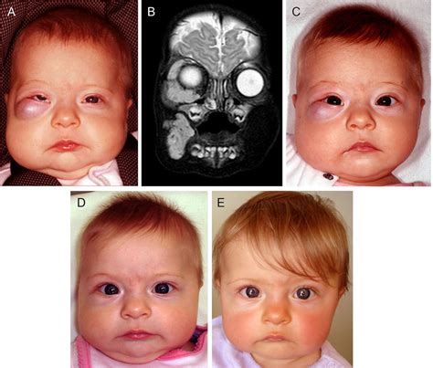 A 4 Month Old Girl Presented With A Rapidly Growing Infantile