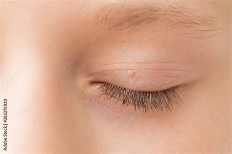 Close Up Of Wart On Eyelid Young Girl With Papillomas On Skin Around