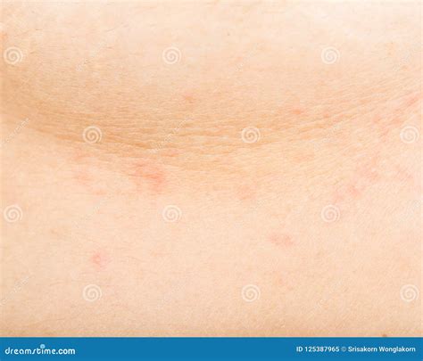 Skin Rashes And Inflammation Stock Image Image Of Healthy Rashes