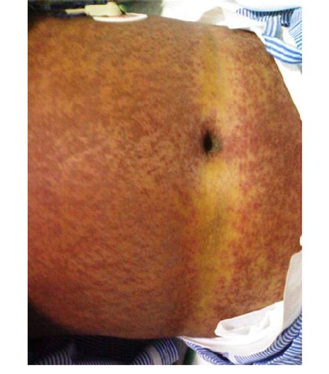 Diffuse Confluent Erythematous Maculopapular Rashes Over Trunk Blanch